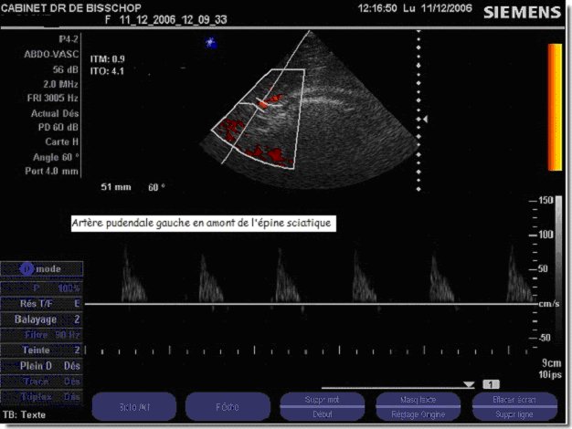 echodoppler
