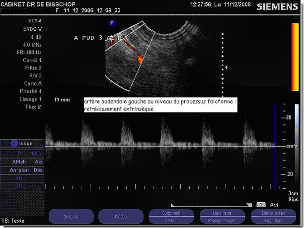 echodoppler