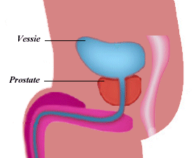 Adenom de prostata recidivant