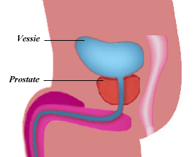 stress et prostatite chronique