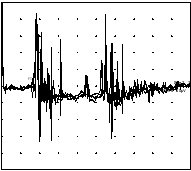 tracé emg