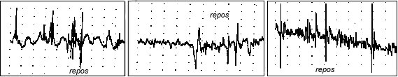 tracé emg