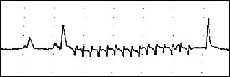 tracé emg
